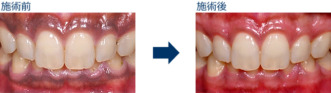 ガムピーリングbefore after