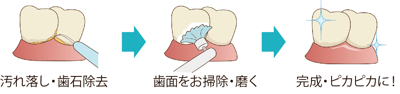 歯のクリーニングの施術