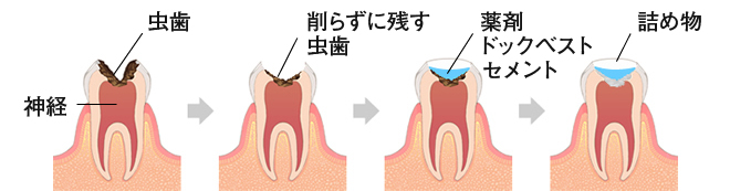 ドックベストセメントの流れ