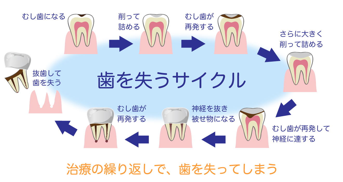 歯を失うサイクル