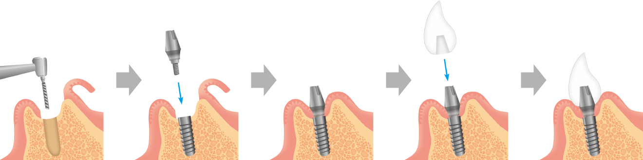 インプラントの説明