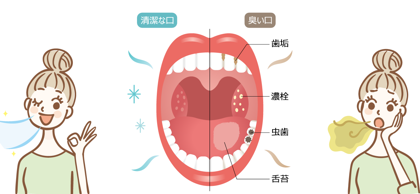 口臭の種類