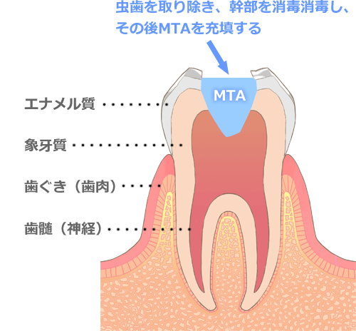 MTAセメントについて