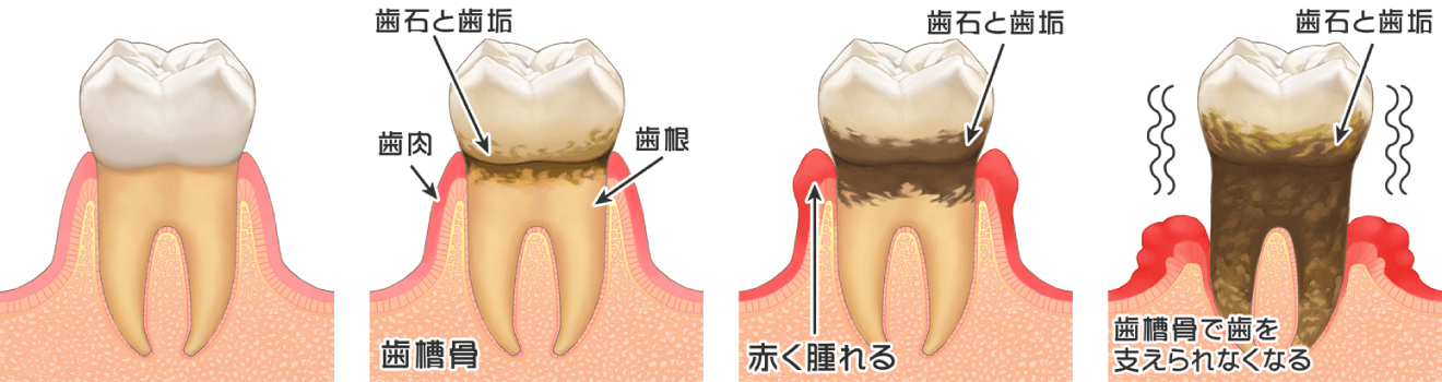 歯周病の進行