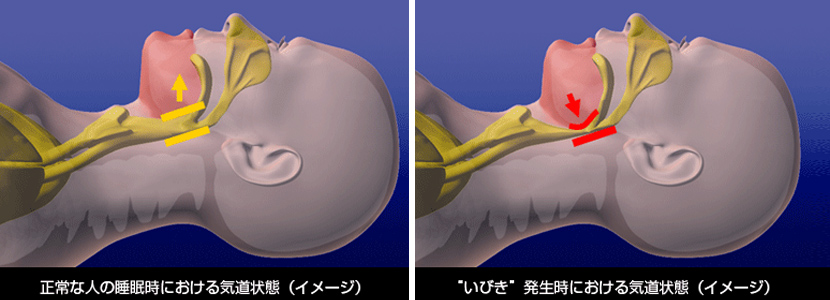 睡眠時の気道状態